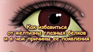 Как избавиться от ЖЕЛТИЗНЫ ГЛАЗНЫХ БЕЛКОВ и в чём причины ее появления