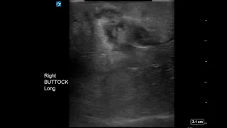 Buttocks Ultrasound: Phlegmon
