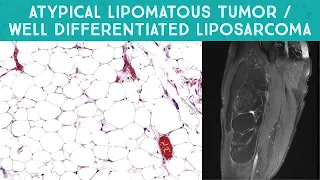 Well differentiated liposarcoma / "Atypical lipomatous tumor" mimicking lipoma (Oregon Case 13)