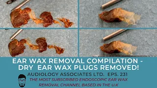 EAR WAX REMOVAL COMPILATION - DRY EAR WAX PLUGS REMOVED - EP 231