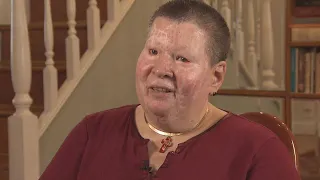 Woman Who Had Acid Thrown on Her Remembers Attack