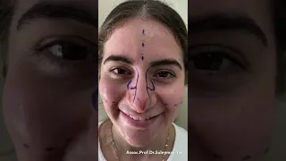 Big and Wide Nose Surgery | Before and After