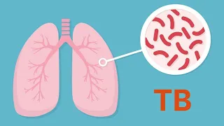 What You Need To Know About Tuberculosis TB...