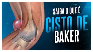 VOCÊ SABE O QUE É CISTO DE BAKER?