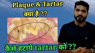 what is Dental plaque and tartar ?? Problems due to tartar?? How to clean the tartar??