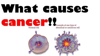 What causes cancer | causes of cancer in men and women