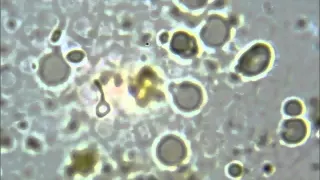 Spirochete turns into L-form in real time