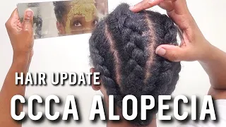 CCCA Alopecia Hair Update | Hair Loss & Scalp Care #alopeciahairloss