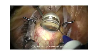 Surgical Case, iTrack™ Advance for Canaloplasty (Jason Cheng, Australia)