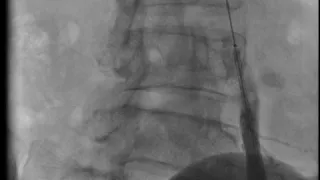 Имплантация баллон-расширяемого стента в ОПА слева