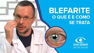 BLEFARITE: A inflamação das pálpebras | Dr. Diego Denardi | 2020