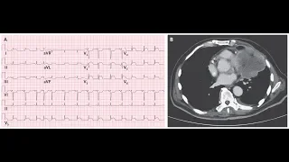 STEMI im EKG Ursache ein invasives Bronchialkarzinom