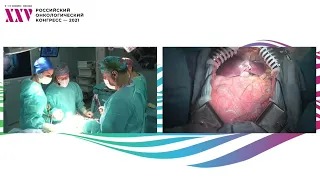 Хирургическая сессия: удаление забрюшинной внеорганной опухоли