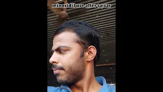 Minoxidil 5% using 1 year hair growth results #minoxidil #hairfall