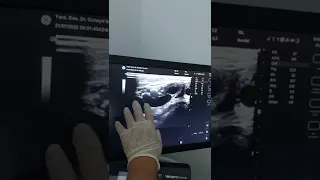 Varicocele Diagnosed (6mm big vein) with Doppler Ultrasound