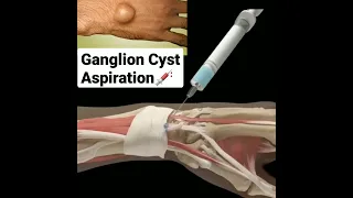 Ganglion Cyst Aspiration💉  #shorts #shortsfeed #shorts #doctor #shortsvideo #short #mbbs #baby #neet