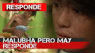 Sakit na Psoriasis, nagpapahirap kay John Carlo | RESPONDE