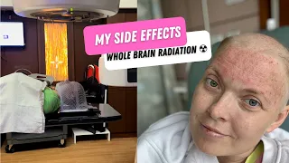 My 6 side effects of whole brain radiation ☢️