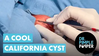 A Cool California Cyst