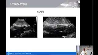 Echokardiographie bei Pulmonaler Hypertonie | Charité | Prof. Dr. med. Frank Edelmann