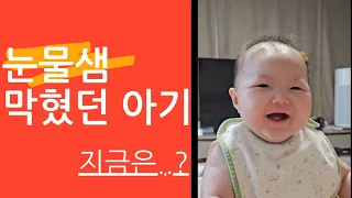 눈물샘 막힌 아기... 지금 상태는??