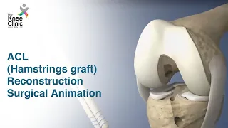 Know more about ACL (Hamstring graft) Reconstruction Surgical Animation