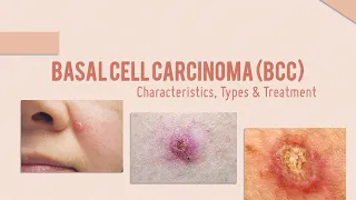 Basal Cell Carcinoma BCC   Characterisitics, Types, Treatment options