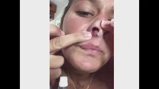 Popping Huge Black Heads & Popping Giant Pimples-Best Popping Video #21