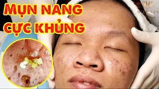 Điều trị mụn hiệu quả tại TPHCM | Hiền Vân spa | Acne Treatment | Đỗ Thu Hiền | 629