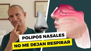 La Nariz tapada: Pólipos Nasales, no me dejan respirar