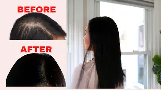 12 Years of caring for thinning hair, this what I will tell you