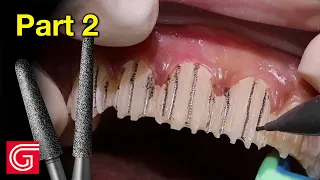 HOW TO Prepare Anterior Teeth #4-13 for Zirconia Veneers