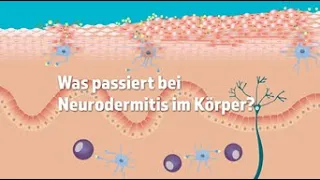 Was passiert bei Neurodermitis im Körper?