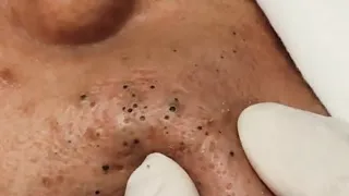 Satisfying Blackhead Removal