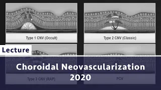 Choroidal Neovascularization 2020