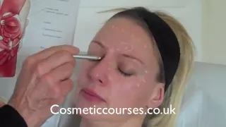 Botox training 2:  Where to place Botox injections