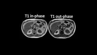 RM do Abdome. T1 In-Phase e Out-Phase