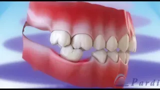 Consequências da perda dos dentes