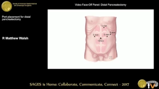 Port placement for distal pancreatectomy