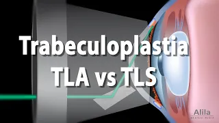 Trabeculoplastia, Animación. Alila Medical Media Español.