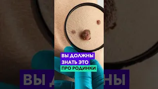 Как понять, нужно ли удалить родинку?