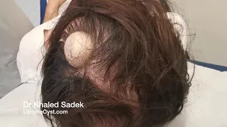 Pilar Cyst or Epidermoid? Dr Khaled Sadek. LipomaCyst.com