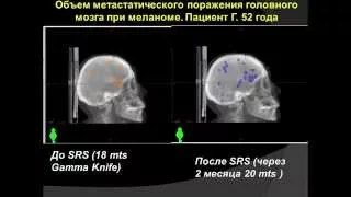 XVII Российский онкологический конгресс С.В. Медведев