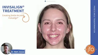 Creating Smile Arc with Invisalign Treatment | Joosse Family Orthodontics | Williamsburg, VA