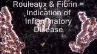 Rouleaux (coin rolls) in Dark Field Microscopy Live Blood Analysis