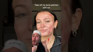 VIRAL ACNE PRODUCT!😱(follow for more!💗) #beauty #skincare #skincareroutine #skin #acne #beautytips