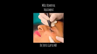 ⚡️Mole Removal by Radio Frequency Ablation⚡️#shorts