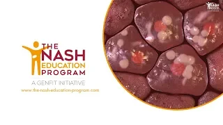 NASH liver disease progression in 3D: from healthy liver to cirrhosis