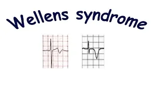 Wellens syndrome