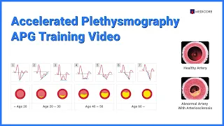 Accelerated Plethysmography - APG Training Video -